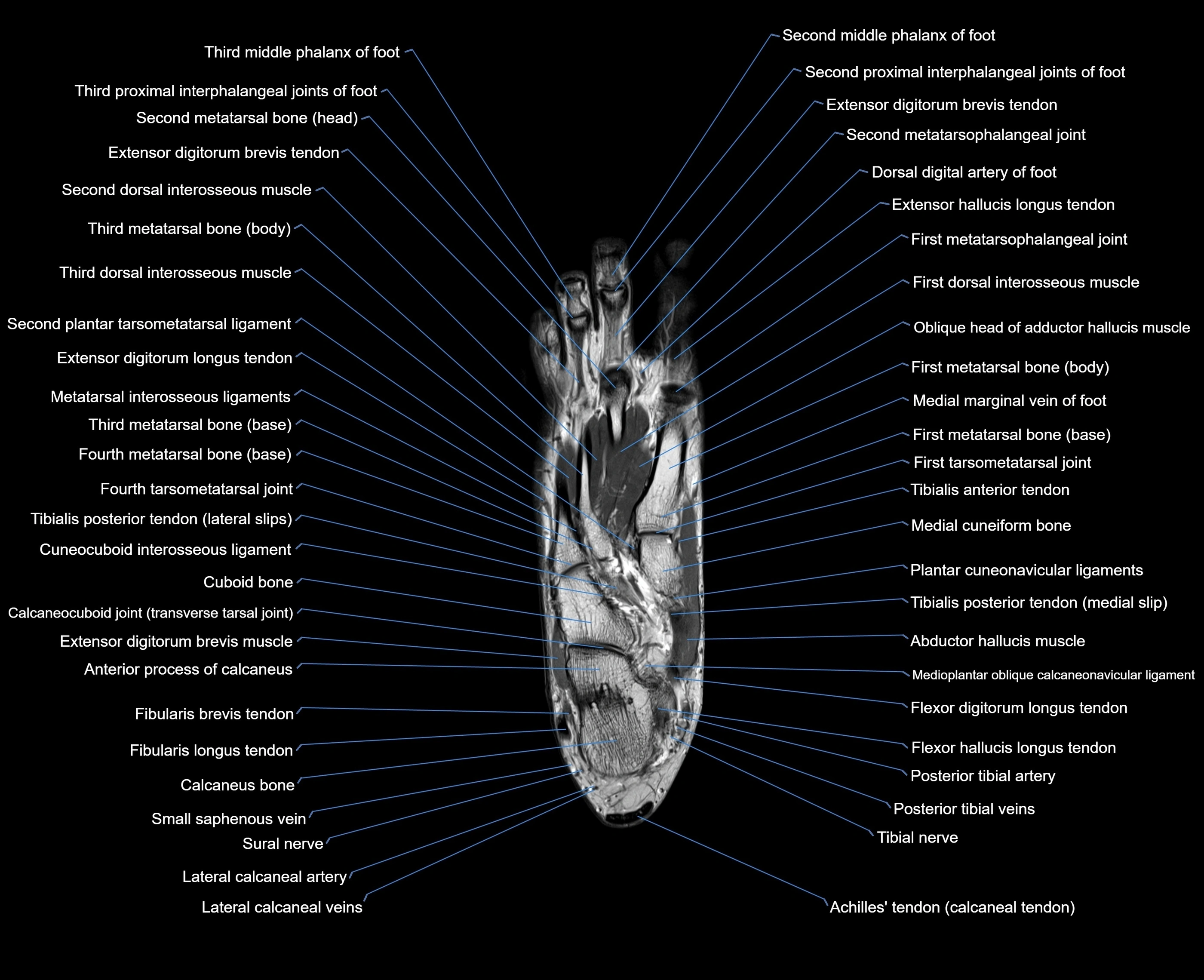 MRI foot coronal cross sectional anatomy 3T  radiology  image-img-00001-00019.webp